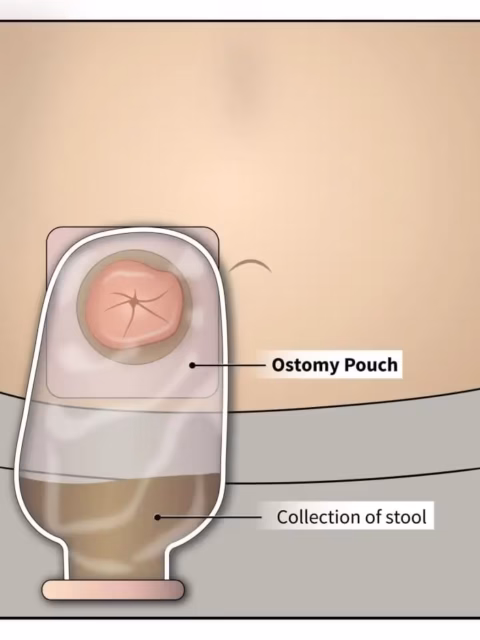 Colostromy Bag
